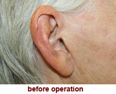 plastic-surgery-prominent-ear 